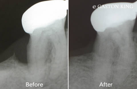 Before and after bone regeneration